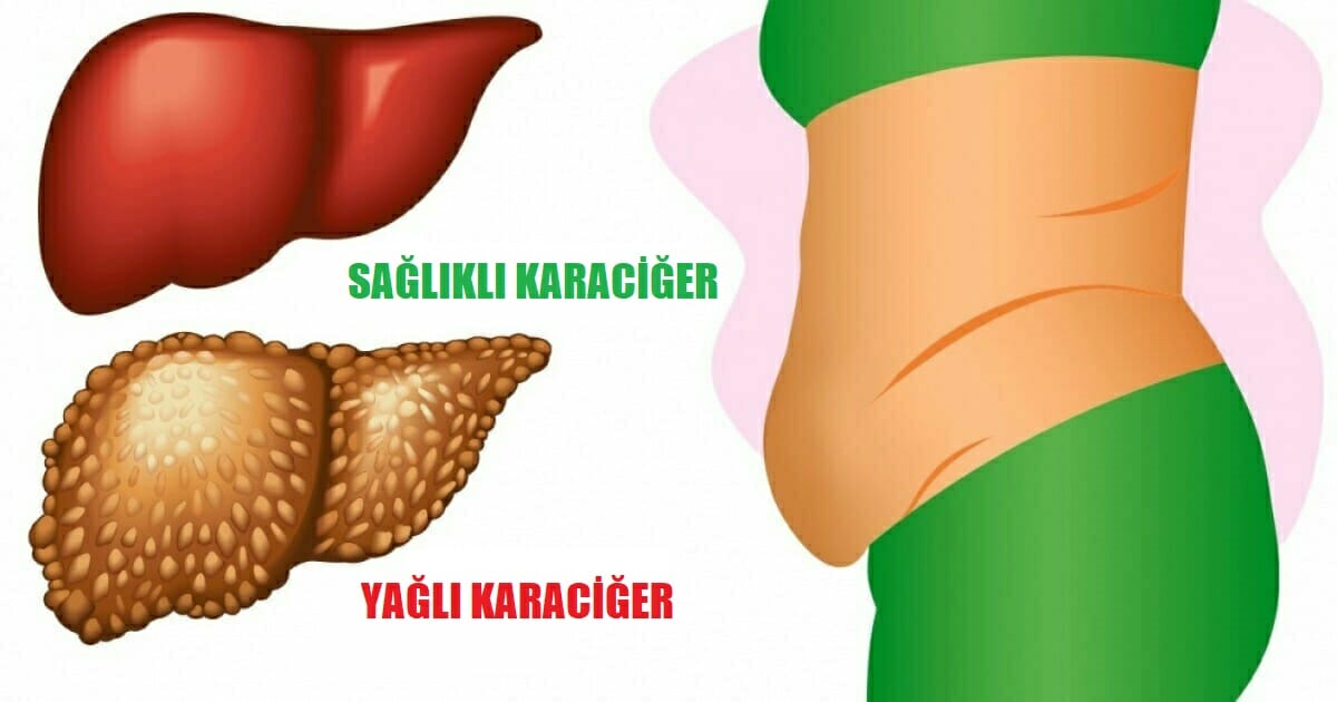 Karaciğerin Toksinlerle Dolu Olduğunu Gösteren 6 İşareti - 6