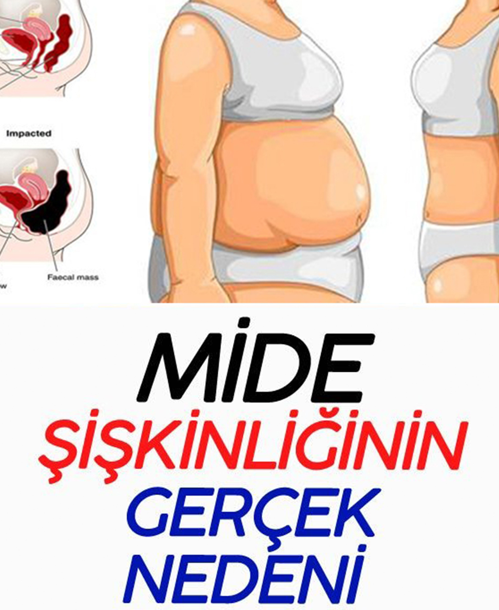 Mide Şişkinliğinin Gerçek Nedeni - 1