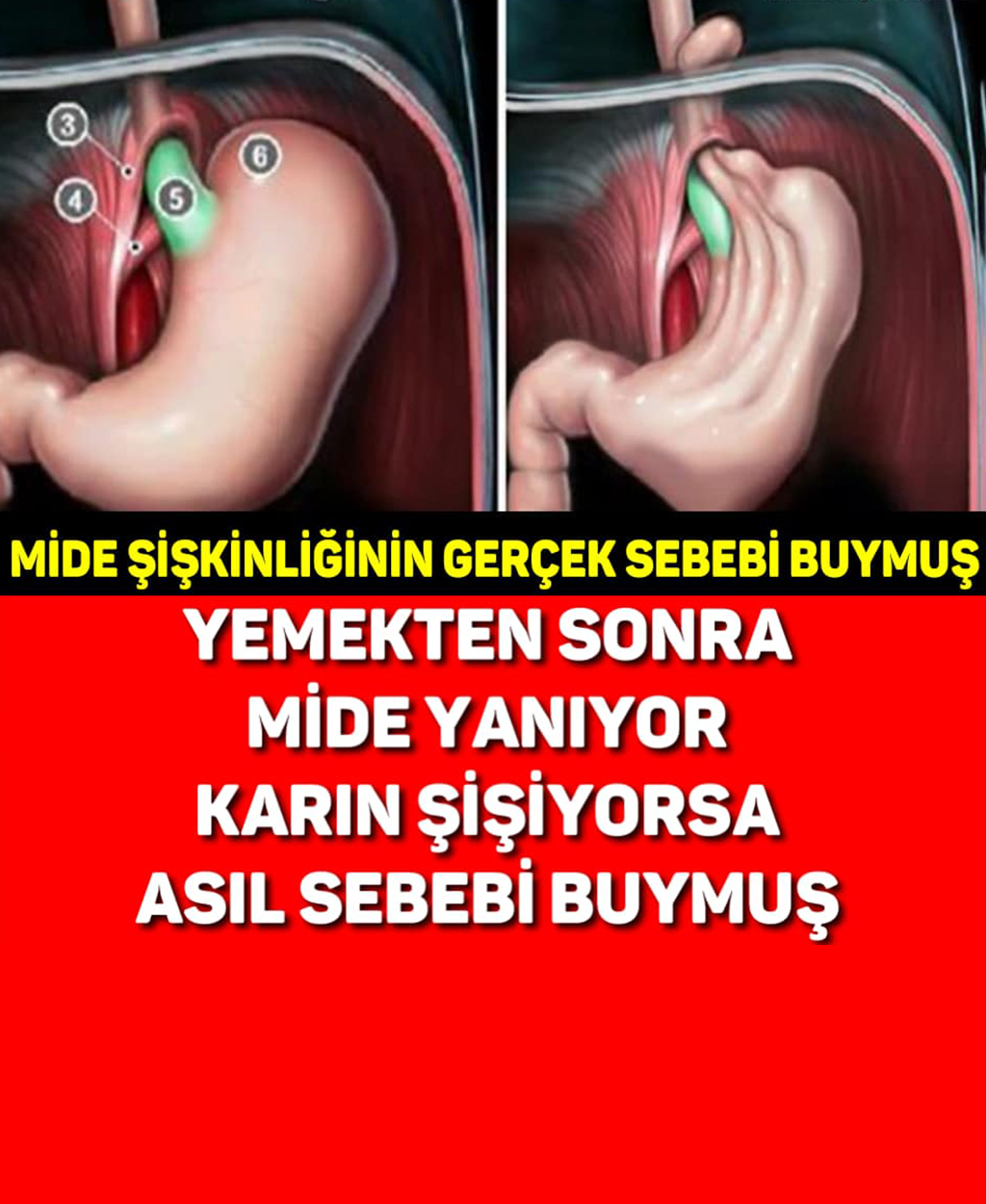 Yemekten Sonra Mide Şişiyorsa - 1