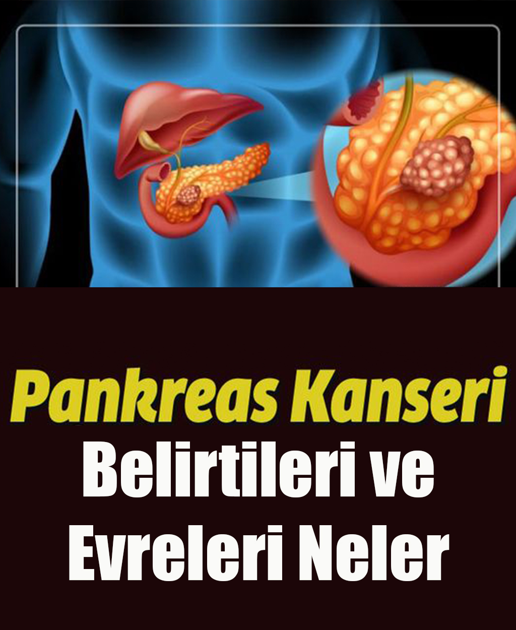 Pankreas Kanseri Belirtileri ve Evreleri Neler - 1