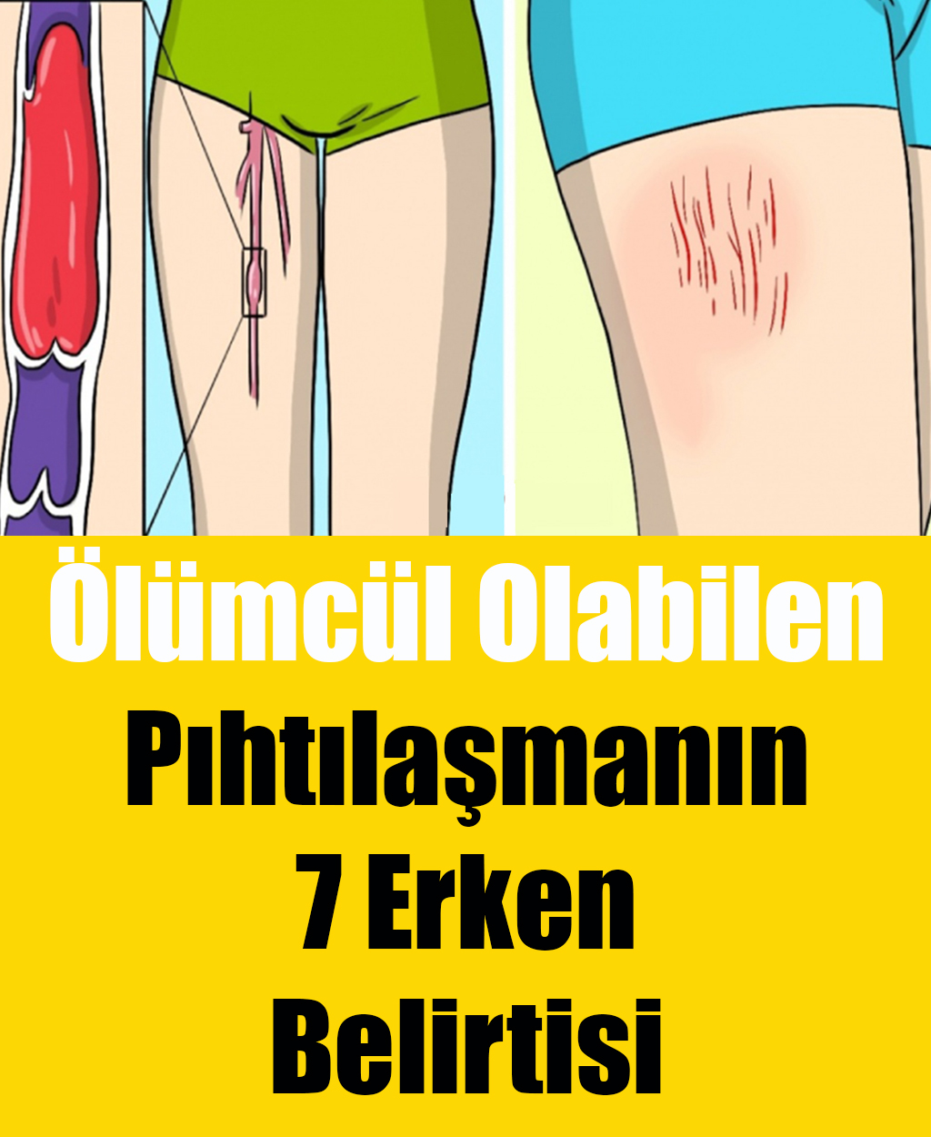 Pıhtılaşmanın 7 Erken Belirtisi	 - 1