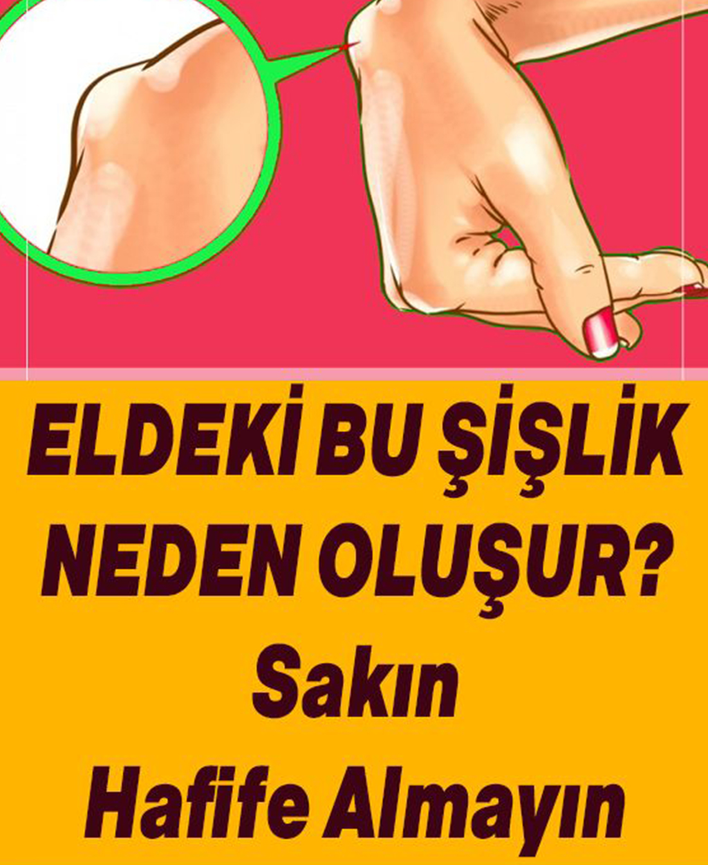 Bilekteki Bu Şişlik Neden Oluşur - 1