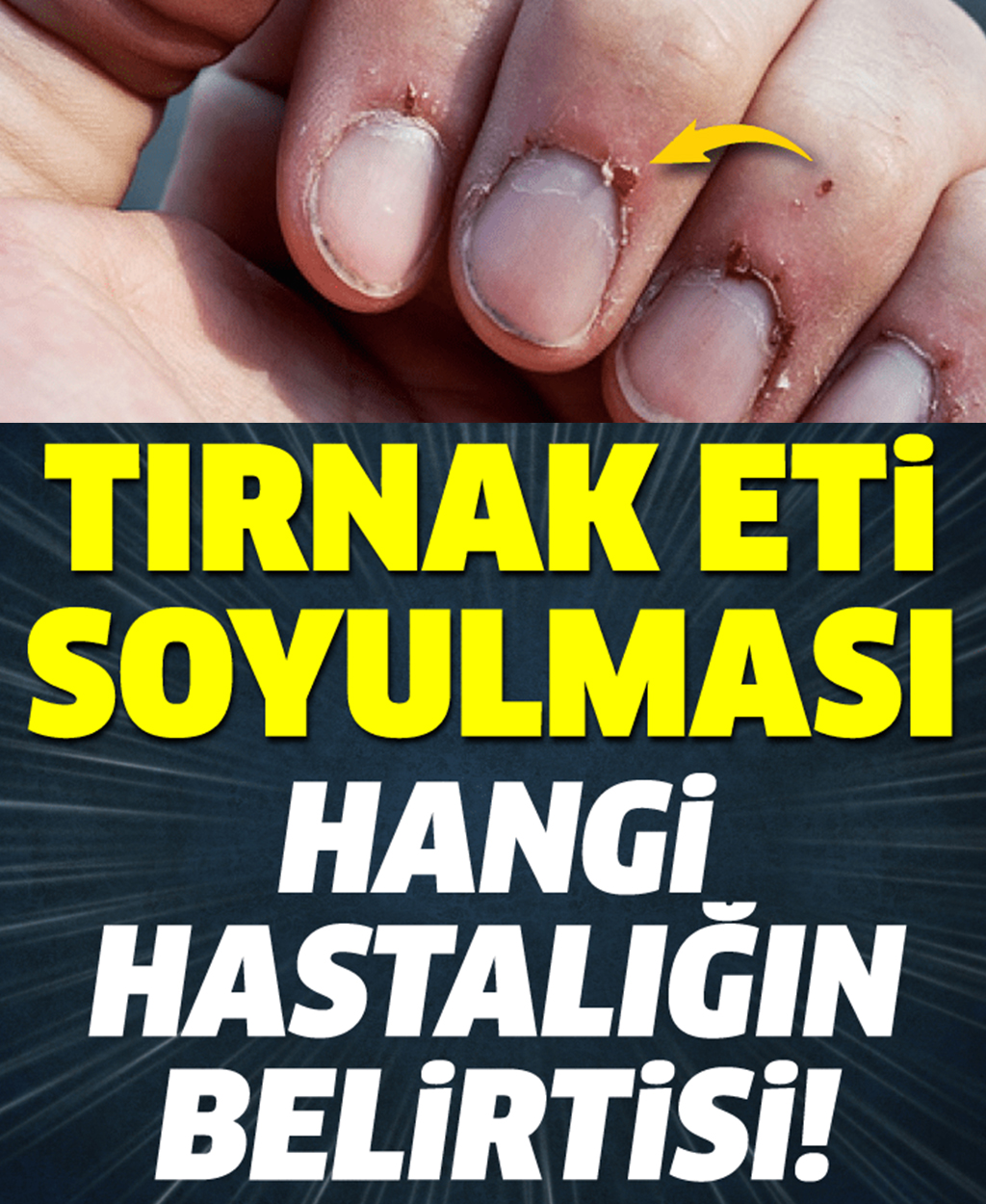 Tırnak Soyulması Hangi Hastalığın Belirtisi - 1