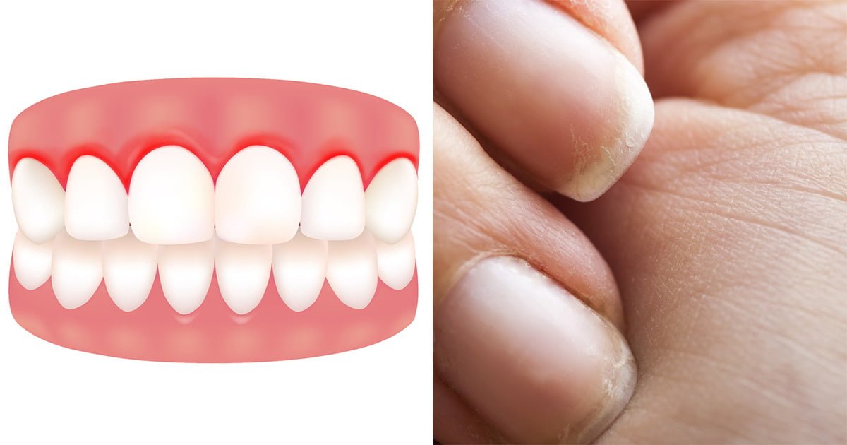 Vücudunuzun C Vitamini Bitmiş Olduğunun 10 Erken Belirtisi - 2