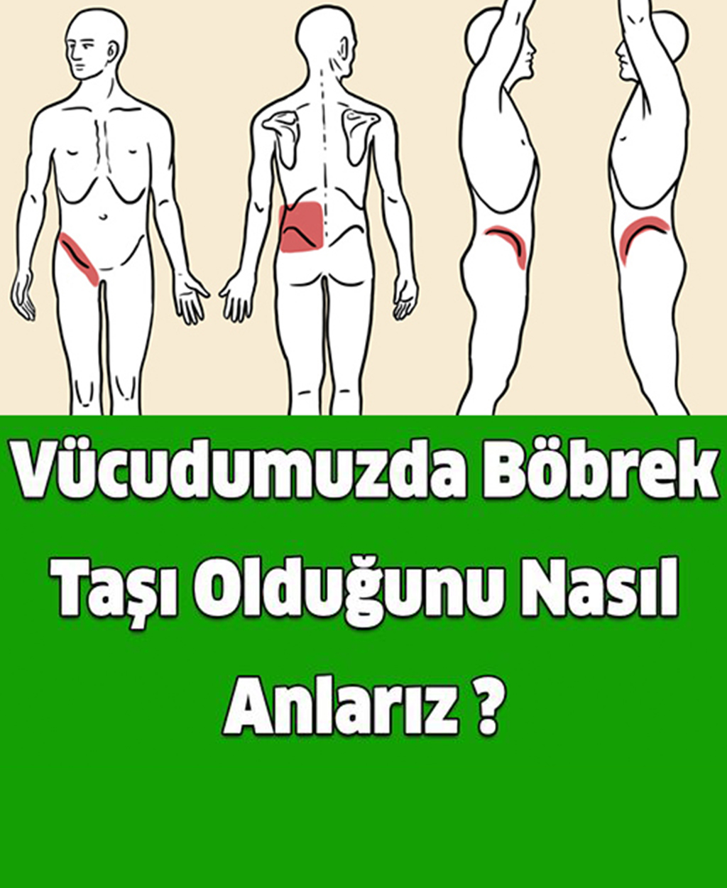 Vücudumuzda Böbrek Taşı Olduğunu Nasıl Anlarız - 1