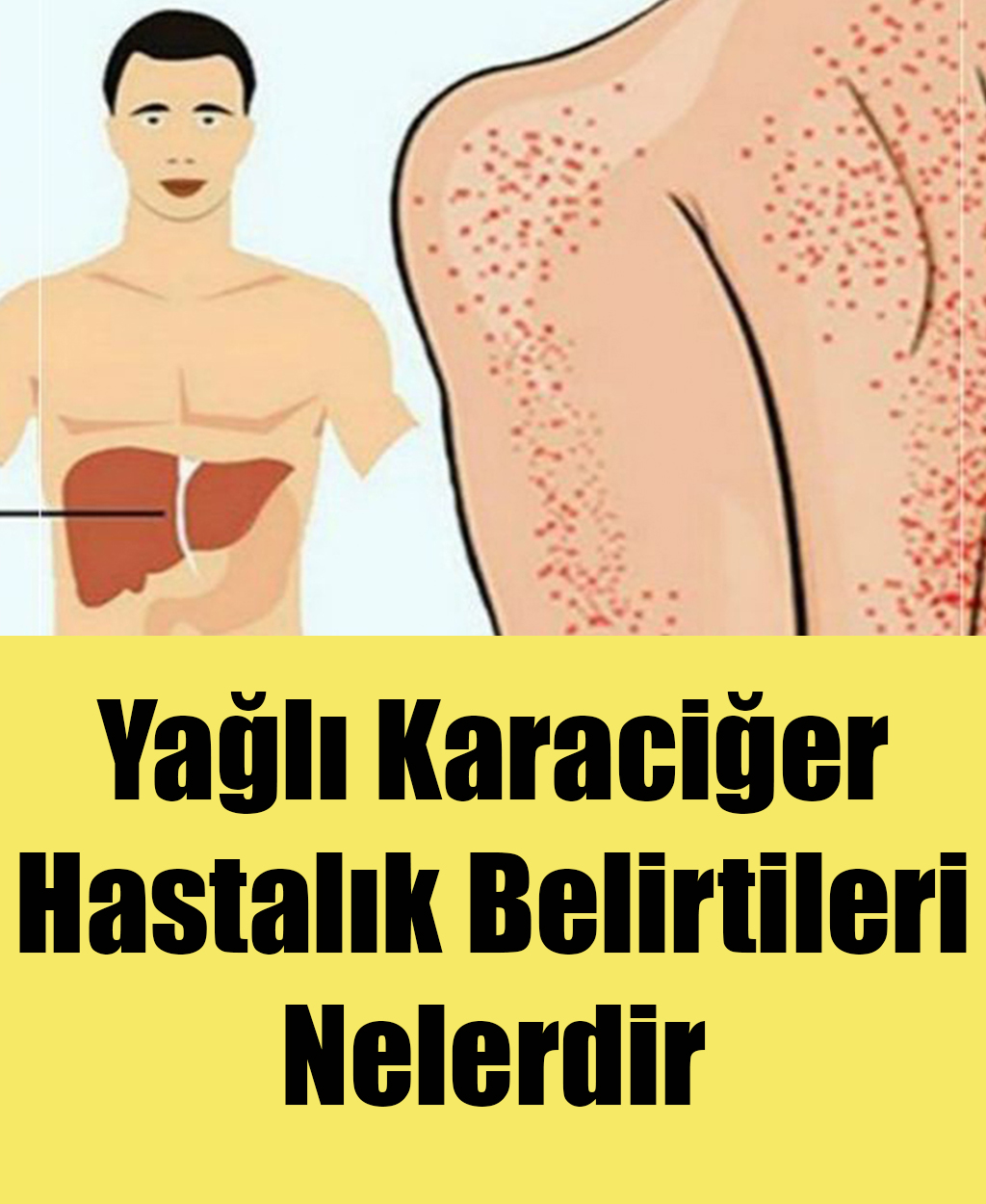 Yağlı Karaciğer Hastalığı Belirtileri - 1