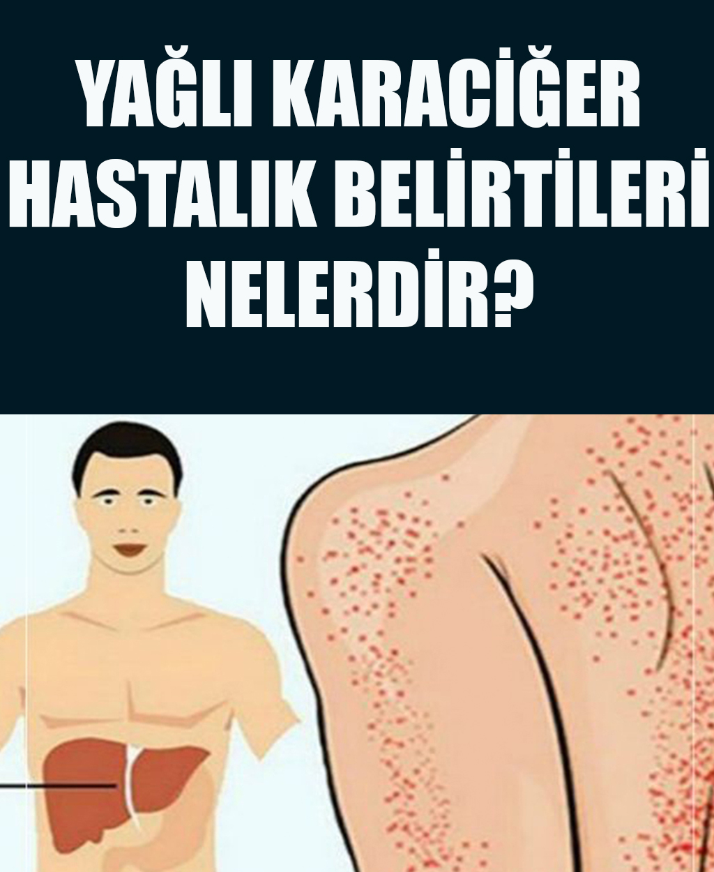 Yağlı Karaciğer Hastalığı Belirtileri - 1