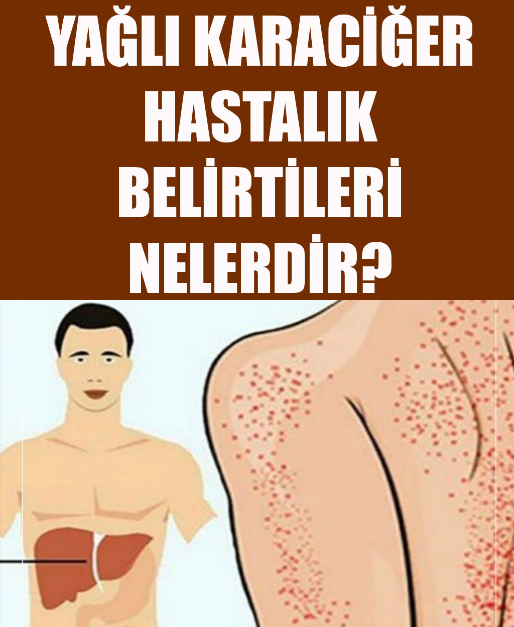 Yağlı Karaciğer Hastalığı Belirtileri	 - 1