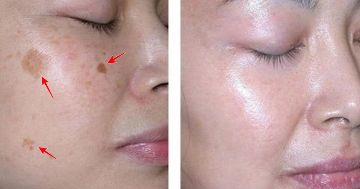 İki Malzemeli Bu Tarif Yüzünüzdeki Lekeleri 3 Gecede Geçiriyor - 2